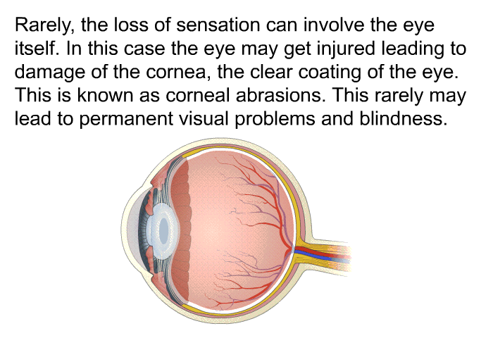 Rarely, the loss of sensation can involve the eye itself. In this case the eye may get injured leading to damage of the cornea, the clear coating of the eye. This is known as corneal abrasions. This rarely may lead to permanent visual problems and blindness.