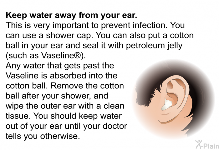 <B>Keep water away from your ear.</B>
This is very important to prevent infection. You can use a shower cap. You can also put a cotton ball in your ear and seal it with petroleum jelly (such as Vaseline ). Any water that gets past the Vaseline is absorbed into the cotton ball. Remove the cotton ball after your shower, and wipe the outer ear with a clean tissue. You should keep water out of your ear until your doctor tells you otherwise.