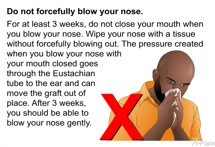 <B>Do not forcefully blow your nose</B>.
For at least 3 weeks, do not close your mouth when you blow your nose. Wipe your nose with a tissue without forcefully blowing out. The pressure created when you blow your nose with your mouth closed goes through the Eustachian tube to the ear and can move the graft out of place. After 3 weeks, you should be able to blow your nose gently.