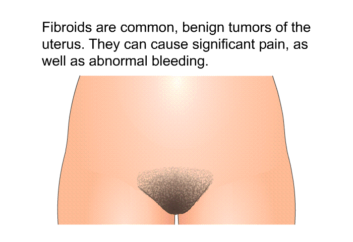 Fibroids are common, benign tumors of the uterus. They can cause significant pain, as well as abnormal bleeding.