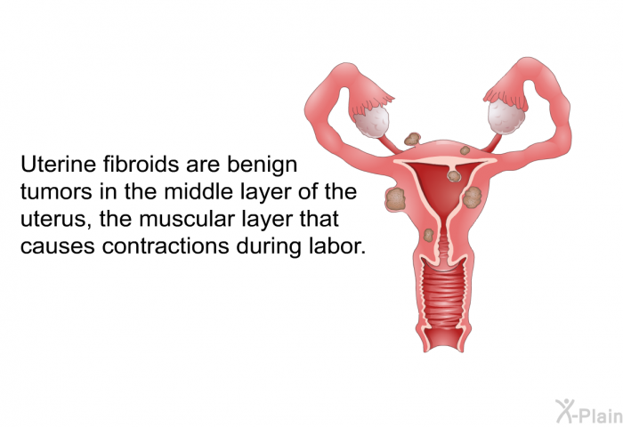 Uterine fibroids are benign tumors in the middle layer of the uterus, the muscular layer that causes contractions during labor.