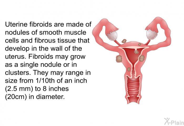 Uterine fibroids are made of nodules of smooth muscle cells and fibrous tissue that develop in the wall of the uterus. Fibroids may grow as a single nodule or in clusters. They may range in size from 1/10th of an inch (2.5 mm) to 8 inches (20cm) in diameter.