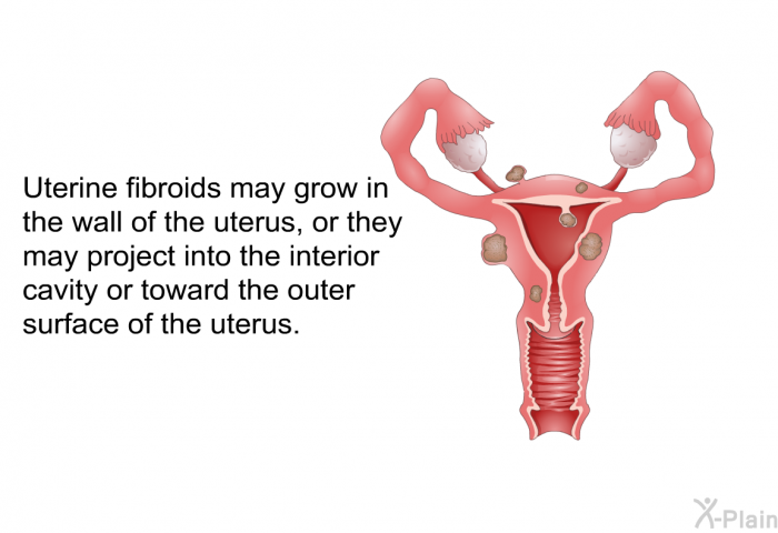 Uterine fibroids may grow in the wall of the uterus, or they may project into the interior cavity or toward the outer surface of the uterus.