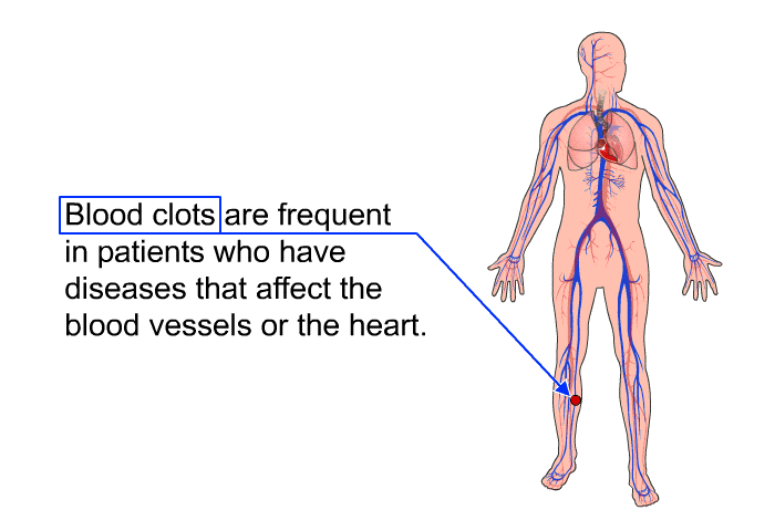 Blood clots are frequent in patients who have diseases that affect the blood vessels or the heart.