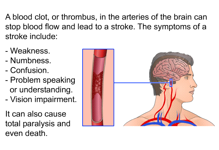 A blood clot, or thrombus, in the arteries of the brain can stop blood flow and lead to a stroke. The symptoms of a stroke include:  Weakness. Numbness. Confusion. Problem speaking or understanding. Vision impairment.

  It can also cause total paralysis and even death.
