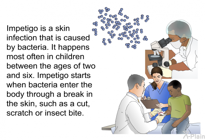 Impetigo is a skin infection that is caused by bacteria. It happens most often in children between the ages of two and six. Impetigo starts when bacteria enter the body through a break in the skin, such as a cut, scratch or insect bite.