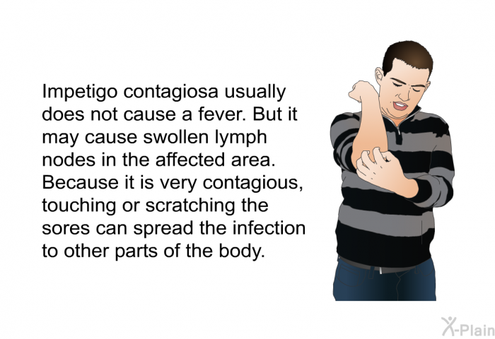 Impetigo contagiosa usually does not cause a fever. But it may cause swollen lymph nodes in the affected area. Because it is very contagious, touching or scratching the sores can spread the infection to other parts of the body.