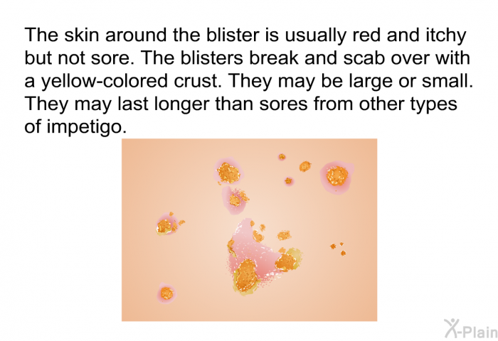 The skin around the blister is usually red and itchy but not sore. The blisters break and scab over with a yellow-colored crust. They may be large or small. They may last longer than sores from other types of impetigo.