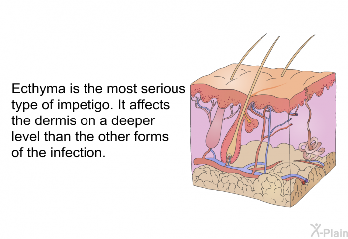 Ecthyma is the most serious type of impetigo. It affects the dermis on a deeper level than the other forms of the infection.