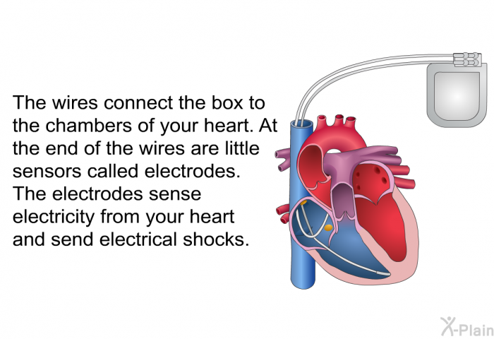 The wires connect the box to the chambers of your heart. At the end of the wires are little sensors called electrodes. The electrodes sense electricity from your heart and send electrical shocks.