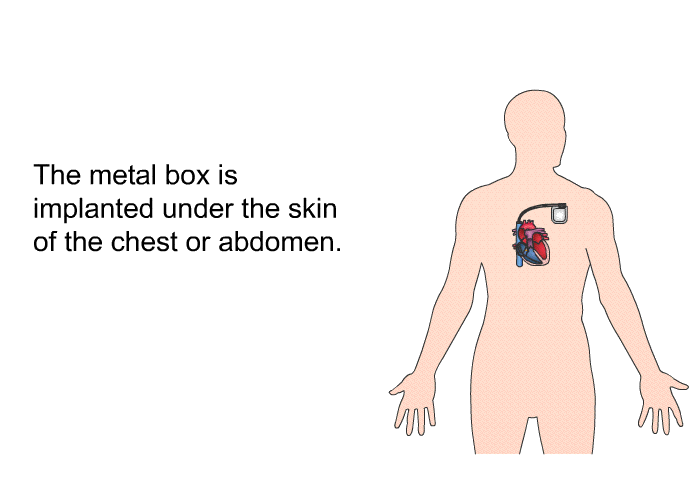 The metal box is implanted under the skin of the chest or abdomen.