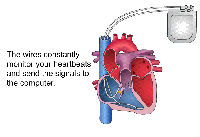 The wires constantly monitor your heartbeats and send the signals to the computer.
