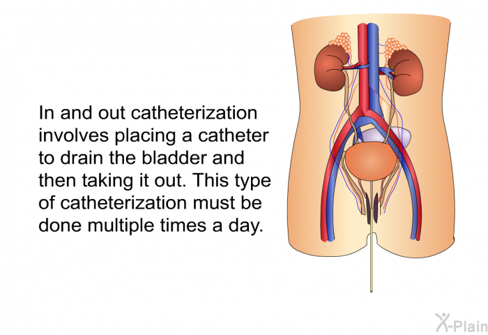 In and out catheterization involves placing a catheter to drain the bladder and then taking it out. This type of catheterization must be done multiple times a day.