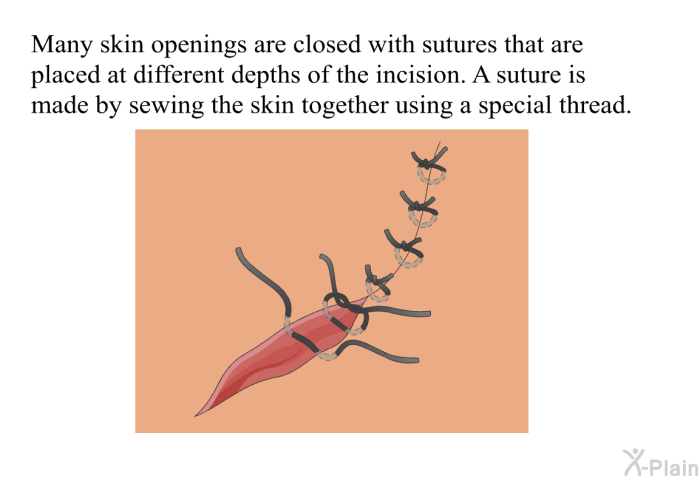 Many skin openings are closed with sutures that are placed at different depths of the incision. A suture is made by sewing the skin together using a special thread.