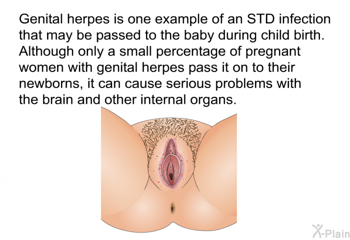 Genital herpes is one example of an STD infection that may be passed to the baby during child birth. Although only a small percentage of pregnant women with genital herpes pass it on to their newborns, it can cause serious problems with the brain and other internal organs.