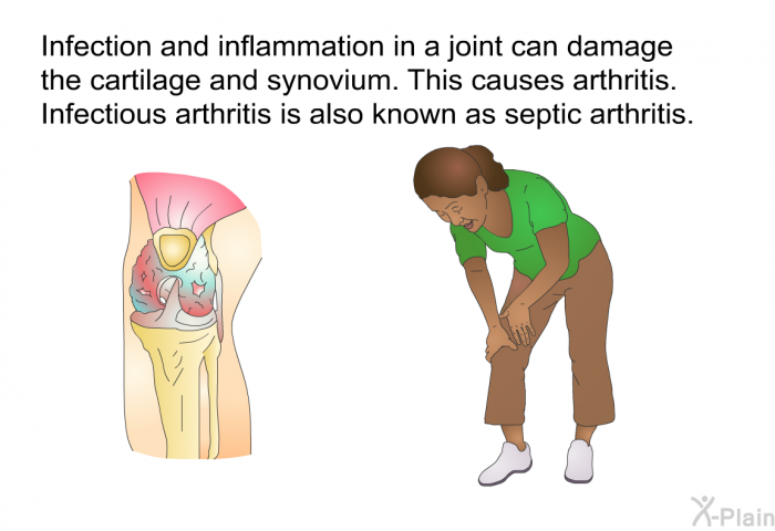 Infection and inflammation in a joint can damage the cartilage and synovium. This causes arthritis. Infectious arthritis is also known as septic arthritis.