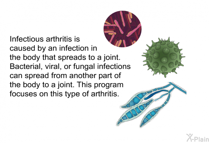 Infectious arthritis is caused by an infection in the body that spreads to a joint. Bacterial, viral, or fungal infections can spread from another part of the body to a joint. This health information focuses on this type of arthritis.