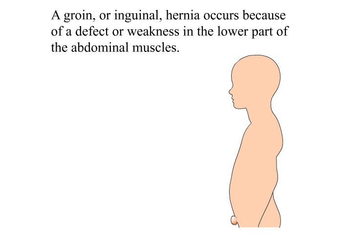 A groin, or inguinal, hernia occurs because of a defect or weakness in the lower part of the abdominal muscles.