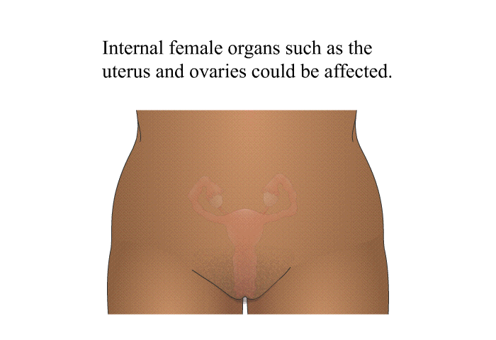 Internal female organs such as the uterus and ovaries could be affected.