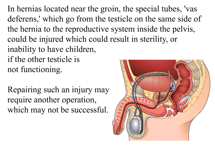 In hernias located near the groin, the special tubes,  vas deferens,' which go from the testicle on the same side of the hernia to the reproductive system inside the pelvis, could be injured which could result in sterility, or inability to have children, if the other testicle is not functioning. Repairing such an injury may require another operation, which may not be successful.