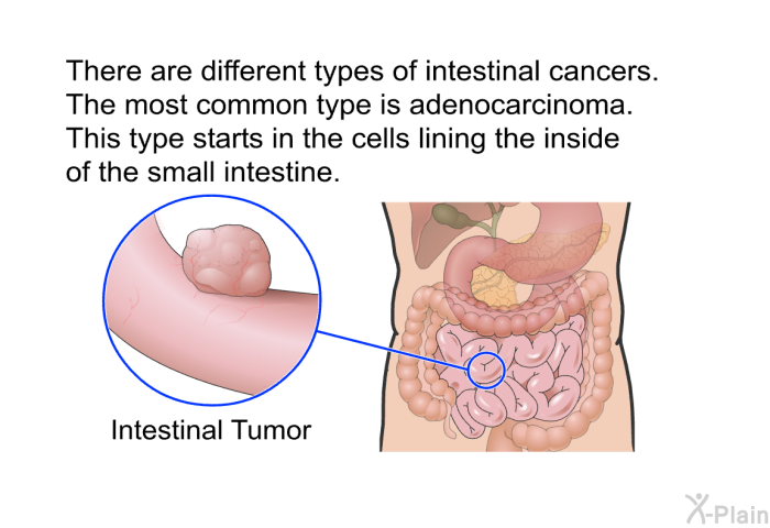 There are different types of intestinal cancers. The most common type is adenocarcinoma. This type starts in the cells lining the inside of the small intestine.