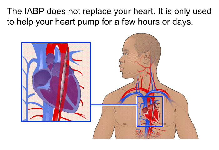 The IABP does not replace your heart. It is only used to help your heart pump for a few hours or days.