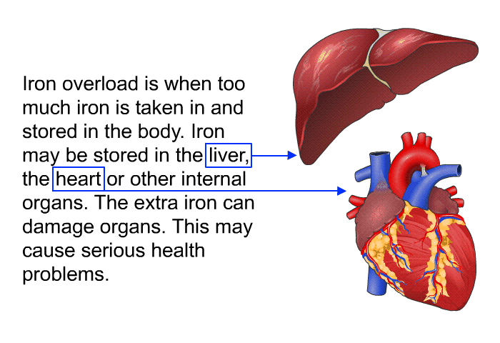 Iron overload is when too much iron is taken in and stored in the body. Iron may be stored in the liver, the heart or other internal organs. The extra iron can damage organs. This may cause serious health problems.
