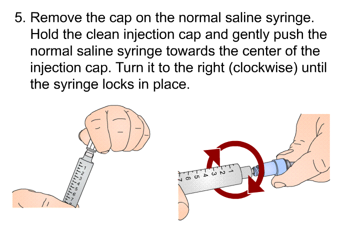 Remove the cap on the normal saline syringe. Hold the clean injection cap and gently push the normal saline syringe towards the center of the injection cap. Turn it to the right (clockwise) until the syringe locks in place.