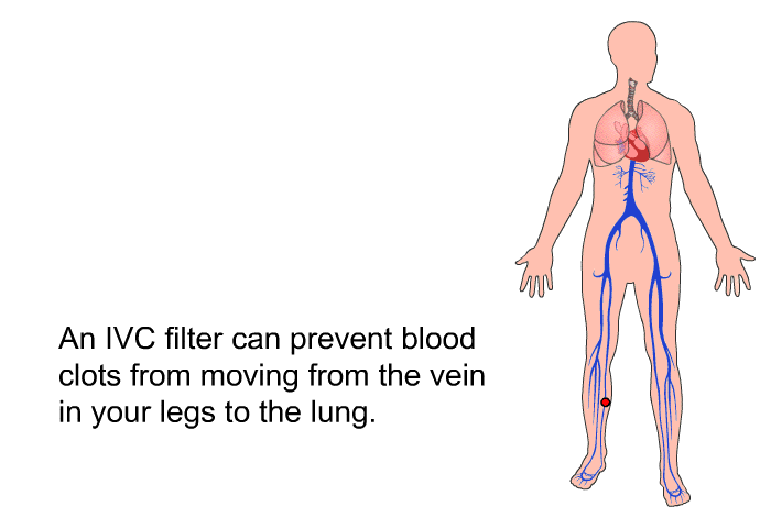 An IVC filter can prevent blood clots from moving from the vein in your legs to the lung.