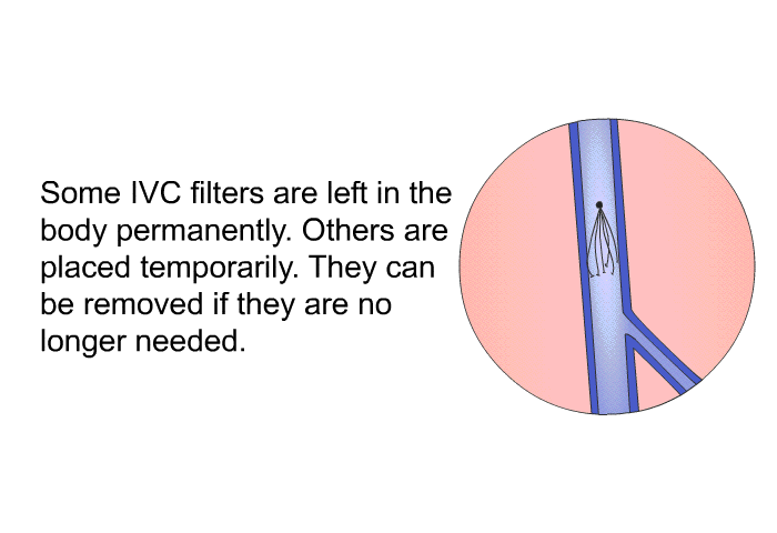 Some IVC filters are left in the body permanently. Others are placed temporarily. They can be removed if they are no longer needed.