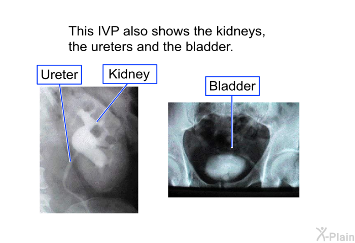 This IVP also shows the kidneys, the ureters and the bladder.