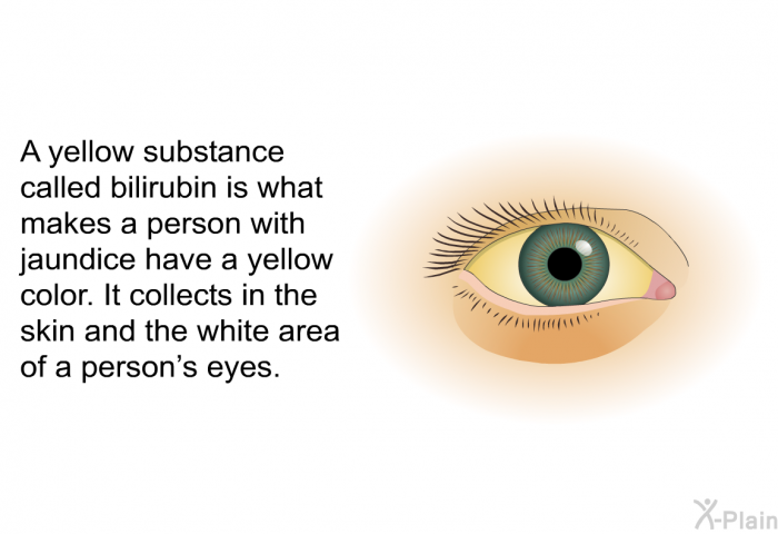 A yellow substance called bilirubin is what makes a person with jaundice have a yellow color. It collects in the skin and the white area of a person's eyes.