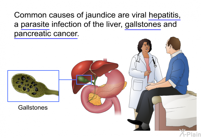 Common causes of jaundice are viral hepatitis, a parasite infection of the liver, gallstones and pancreatic cancer.