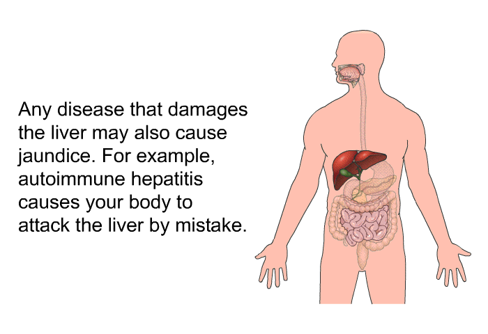 Any disease that damages the liver may also cause jaundice. For example, autoimmune hepatitis causes your body to attack the liver by mistake.