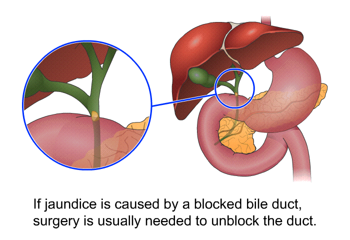 If jaundice is caused by a blocked bile duct, surgery is usually needed to unblock the duct.