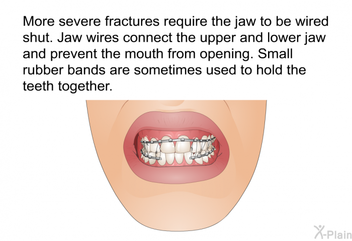 More severe fractures require the jaw to be wired shut. Jaw wires connect the upper and lower jaw and prevent the mouth from opening. Small rubber bands are sometimes used to hold the teeth together.