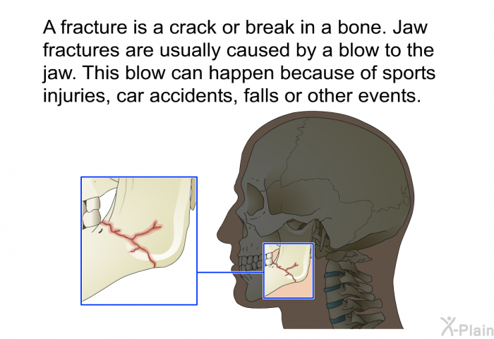 A fracture is a crack or break in a bone. Jaw fractures are usually caused by a blow to the jaw. This blow can happen because of sports injuries, car accidents, falls or other events.