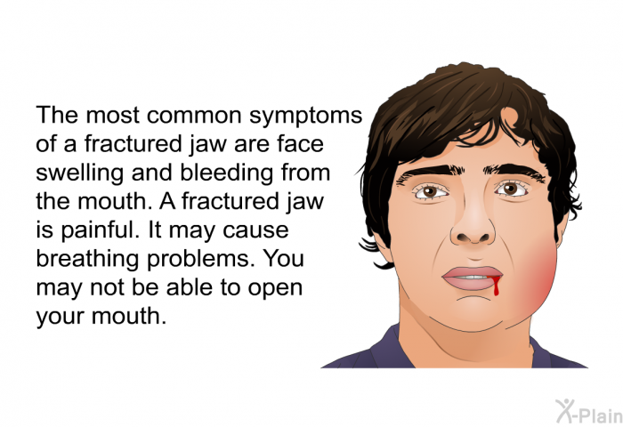 The most common symptoms of a fractured jaw are face swelling and bleeding from the mouth. A fractured jaw is painful. It may cause breathing problems. You may not be able to open your mouth.