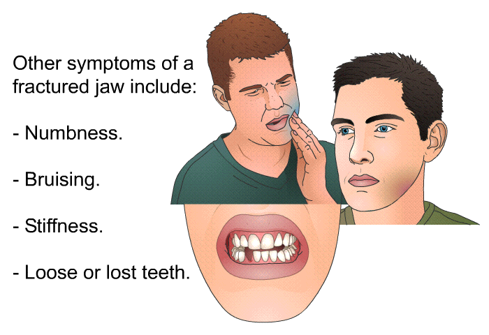 Other symptoms of a fractured jaw include:  Numbness. Bruising. Stiffness. Loose or lost teeth.