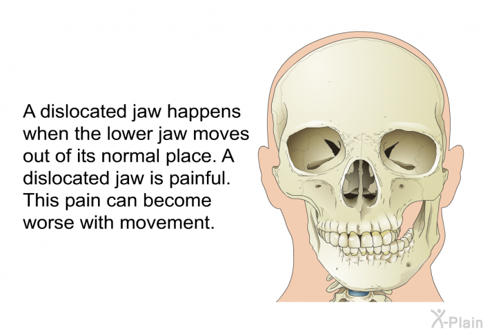 A dislocated jaw happens when the lower jaw moves out of its normal place. A dislocated jaw is painful. This pain can become worse with movement.