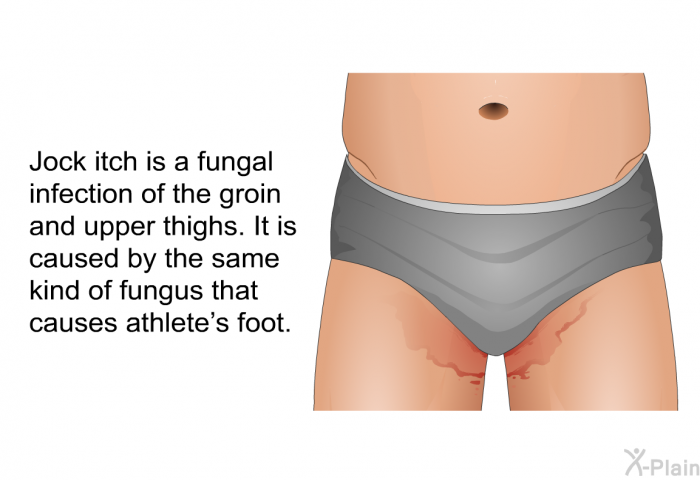 Jock itch is a fungal infection of the groin and upper thighs. It is caused by the same kind of fungus that causes athlete's foot.
