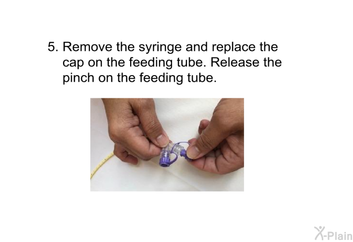 Remove the syringe and replace the cap on the feeding tube. Release the pinch on the feeding tube.