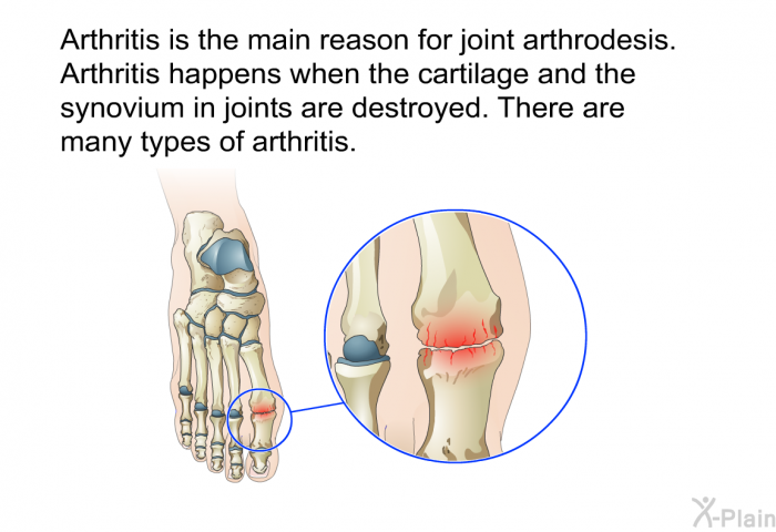 Arthritis is the main reason for joint arthrodesis. Arthritis happens when the cartilage and the synovium in joints are destroyed. There are many types of arthritis.