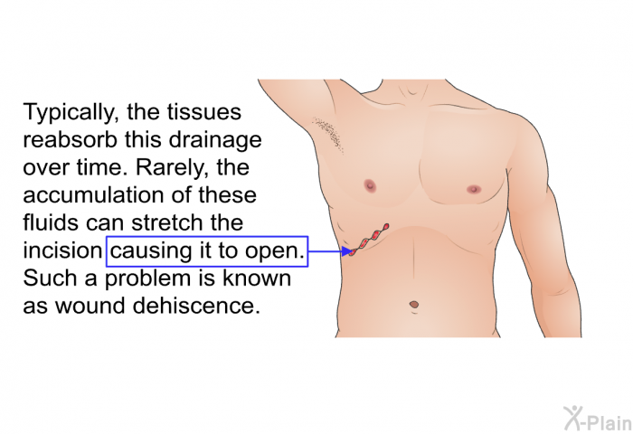 Typically, the tissues reabsorb this drainage over time. Rarely, the accumulation of these fluids can stretch the incision causing it to open. Such a problem is known as wound dehiscence.