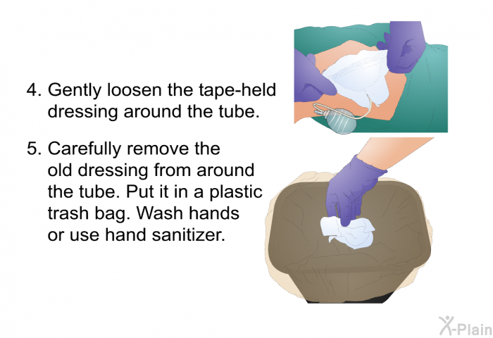 Gently loosen the tape-held dressing around the tube. Carefully remove the old dressing from around the tube. Put it in a plastic trash bag. Wash hands or use hand sanitizer.
