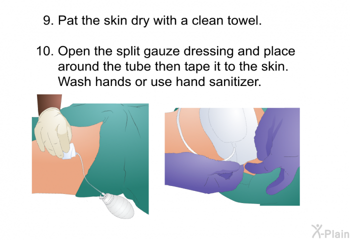 Pat the skin dry with a clean towel. Open the split gauze dressing and place around the tube then tape it to the skin. Wash hands or use hand sanitizer.
