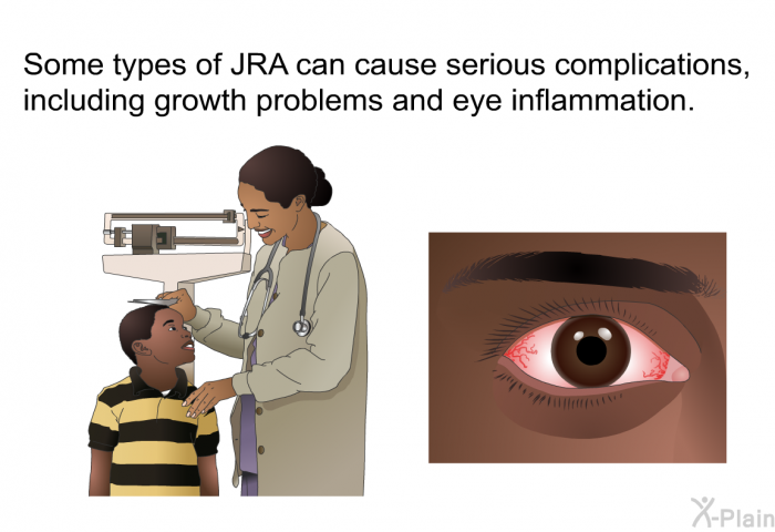 Some types of JRA can cause serious complications, including growth problems and eye inflammation.