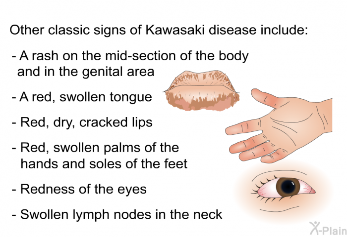 Other classic signs of Kawasaki disease include:  A rash on the mid-section of the body and in the genital area A red, swollen tongue Red, dry, cracked lips Red, swollen palms of the hands and soles of the feet Redness of the eyes Swollen lymph nodes in the neck