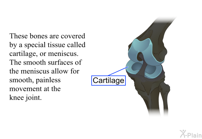 These bones are covered by a special tissue called cartilage, or meniscus. The smooth surfaces of the meniscus allow for smooth, painless movement at the knee joint.