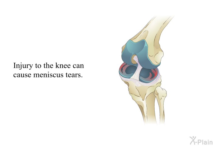 Injury to the knee can cause meniscus tears.